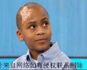 老年人白癜风如何正确医治