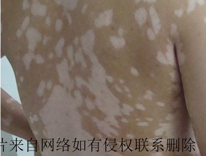 不同时期的白癜风有何症状特点