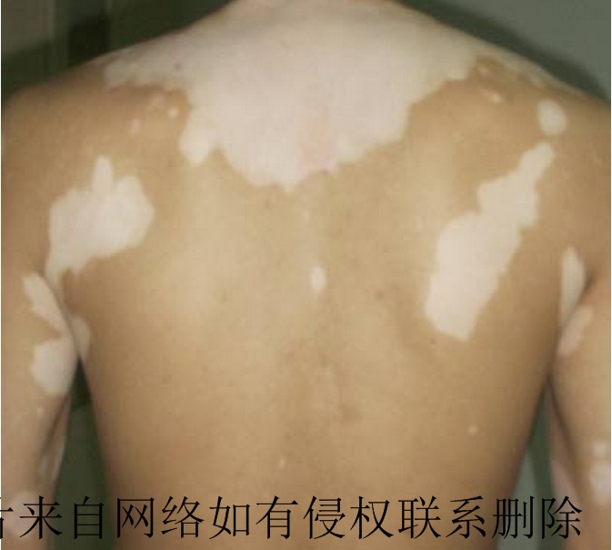 局限性白癜风想要治疗好注重哪些事项