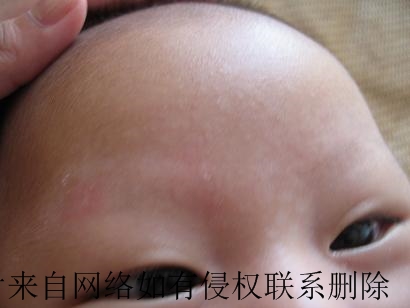 伍德灯检查白癜风好么