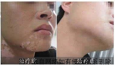 男性白癜风的危害体现在哪呢