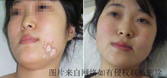 怎么降低白癜风带给的心理伤害