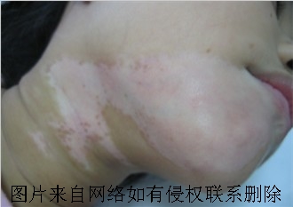 白癜风患者注意哪些生活调理