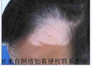 老年人患白癜风应注意什么