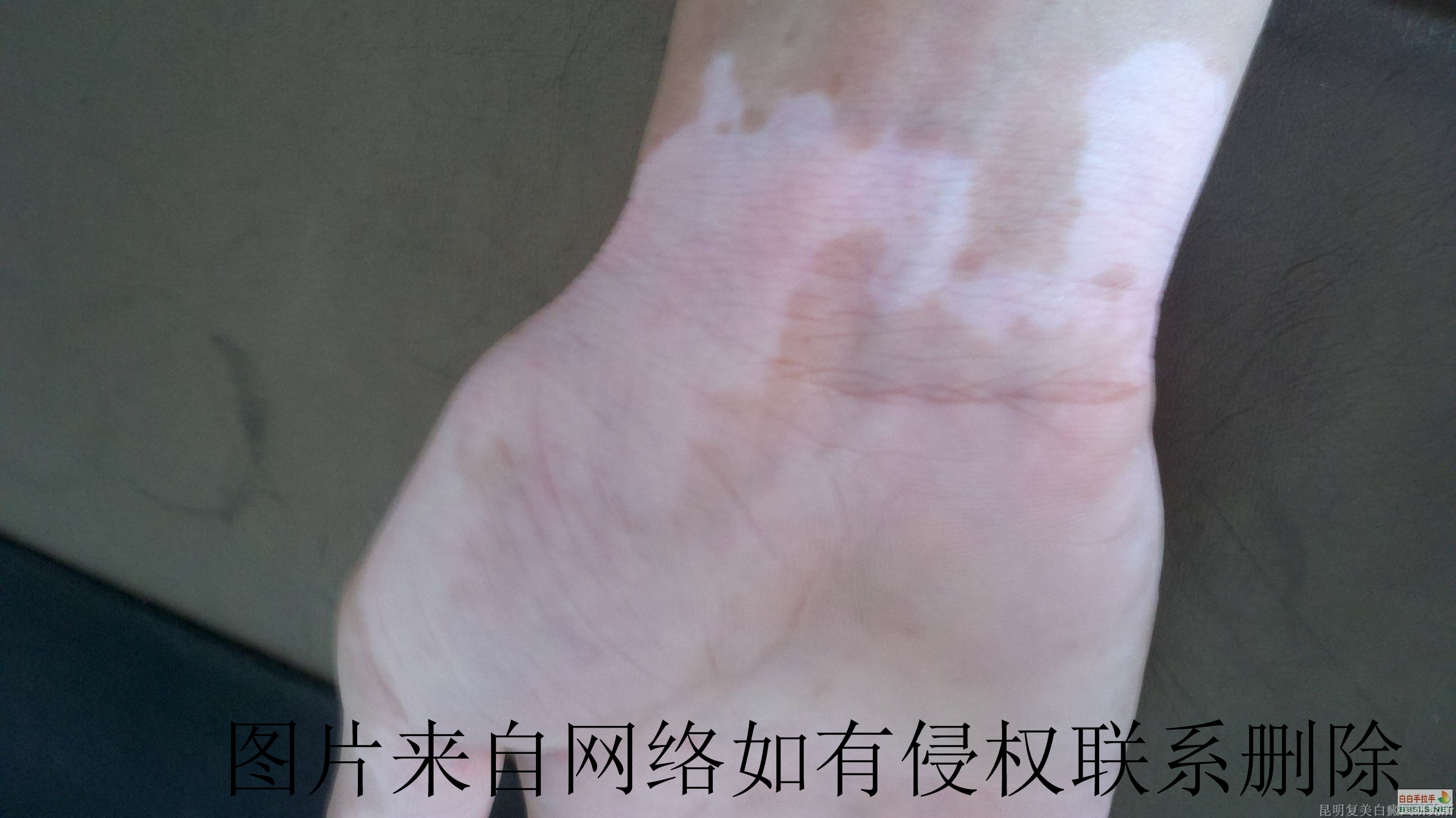 白癜风需要注意的事项有哪些