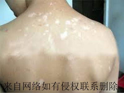 白癜风常见的危害性有哪些