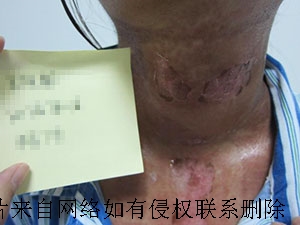 老年人白癜风怎么调节心理