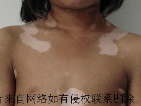 过量服用微C为什么会导致白癜风