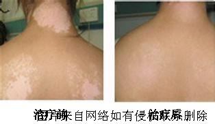 发展期白癜风有何症状