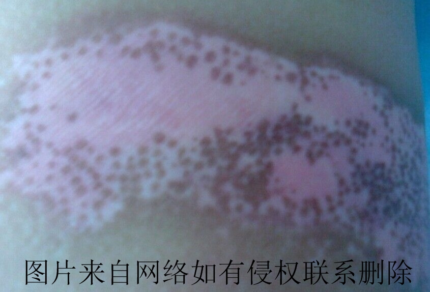 眼部白癜风会让视力变差么