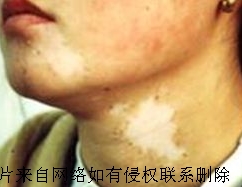 颈部白癜风治疗中注意
