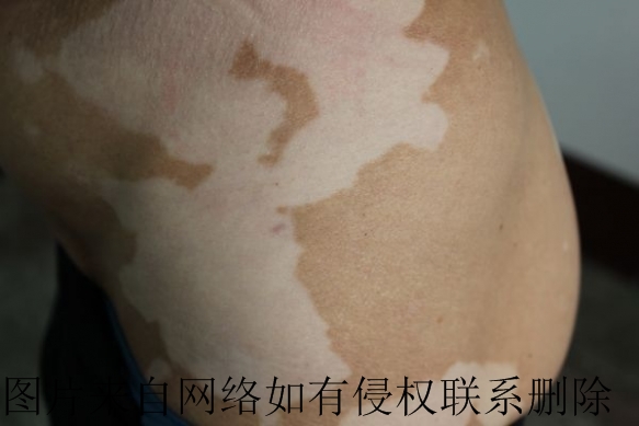 白癜风治疗要采取什么措施