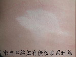 女人爱发脾气会导致白癜风么