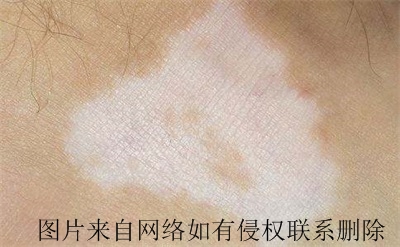 白癜风要怎么进行自我调节