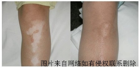 老年白斑和白癜风有什么区别