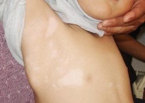 白癜风早期症状 白癜风早期症状