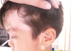 小孩白癜风症状 小孩白癜风症状