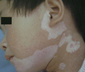 儿童白癜风应该如何治好