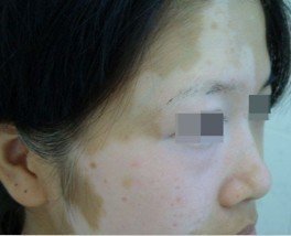 白斑病应该如何预防呢