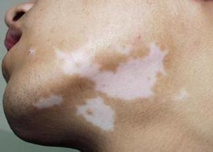 对于白癜风症状我们知多少