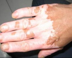 我们该怎样治疗白癜风才最有效果