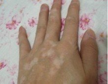 我们如何及时做好白癜风护理工作