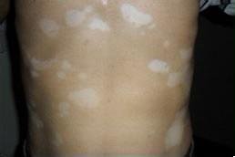 治疗白癜风需花费多少钱