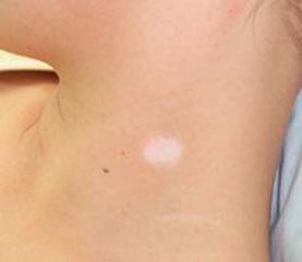 白癜风早期症状