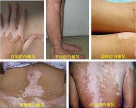 白癜风常见类型