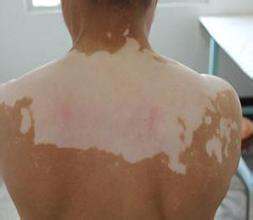 男性白癜风患者心理