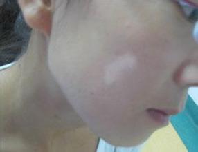 女性白癜风会遗传吗