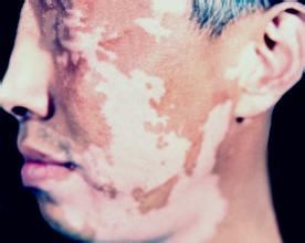 夏季面部白癜风为什么容易扩散