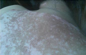 白癜风症状主要表现