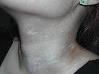 白癜风复发几率高吗