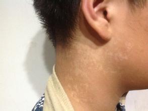 颈部白癜风