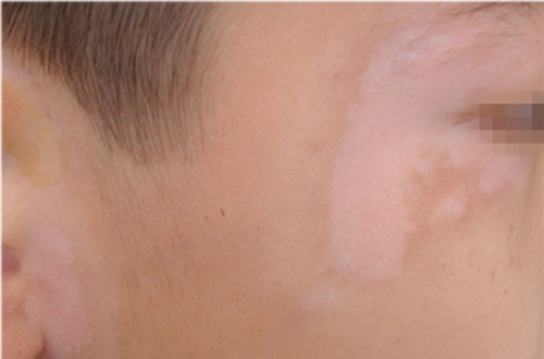 面部白癜风 面部白癜风