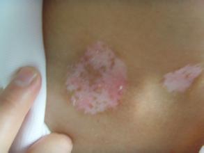 不完全性白癜风 不完全性白癜风