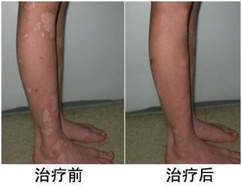 脚部白癜风 脚部白癜风