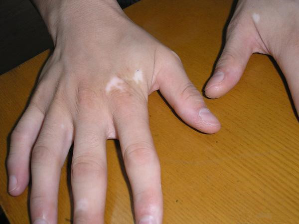 手部白癜风 手部白癜风