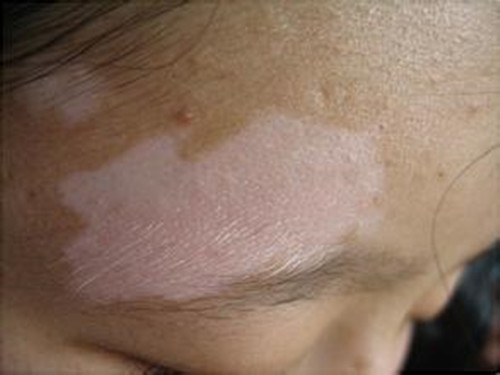 儿童白癜风 儿童白癜风