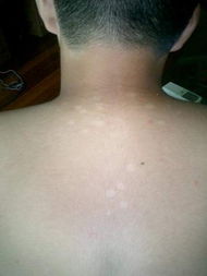 泛发性白癜风 泛发性白癜风