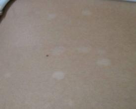 白癜风图片 白癜风图片