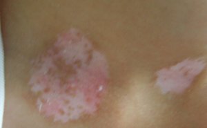 白癜风图片 白癜风图片