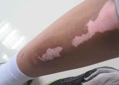 白癜风图片 白癜风图片