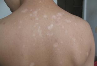 白癜风图片 白癜风图片