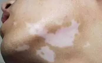 颈部白癜风的五大危害 颈部白癜风的五大危害