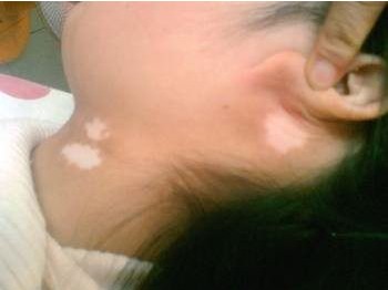 颈部白斑,颈部白癜风的症状 颈部白斑,颈部白癜风的症状