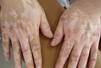 男性手上有白斑需要注意哪些饮食事项 男性手上有白斑需要注意哪些饮食事项