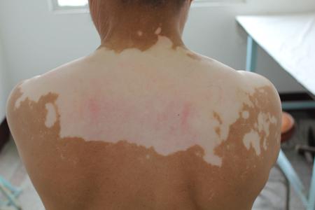 白癜风背部应该如何治疗