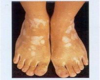 脚部白癜风的危害有哪些